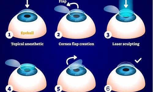 近视眼手术lasik中文名字_lasik