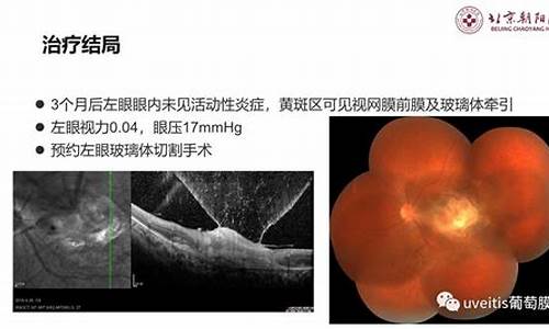 眼科医生陶勇葡萄膜炎并发玻璃体混浊_葡萄