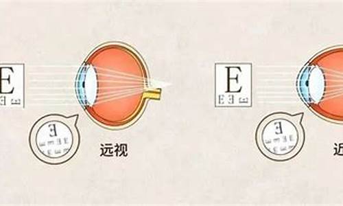 近视相差200度,如何配镜_28岁双眼近视相差500度怎么配镜