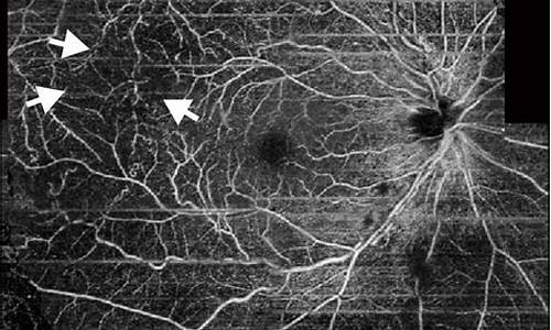 眼科oct检查怎么做_眼科oct检查什么病