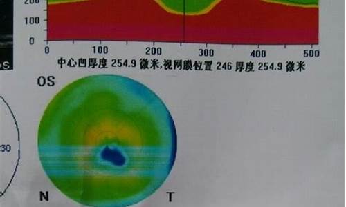 眼科oct检查结果怎么看_怎样看懂眼科oct报告