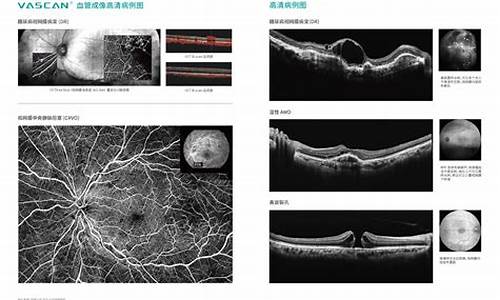 OCT眼科是什么意思_oct眼科