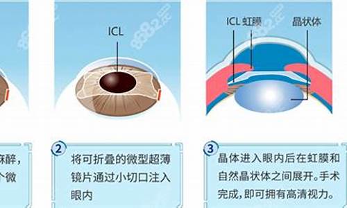 icl眼科手术_icl 眼科