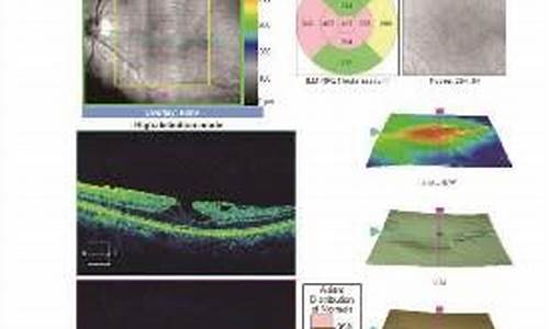 眼科oct检查报告解读_眼科检查oct是什么意思