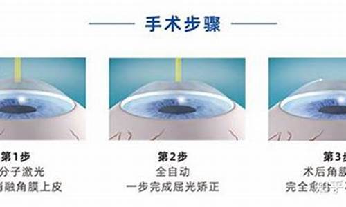 近视眼手术的分类_眼科近视手术分类